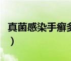 真菌感染手癬多久治愈（真菌感染手癬怎么辦）