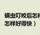 螨蟲叮咬后怎樣徹底消除小妙招（螨蟲叮咬后怎樣好得快）
