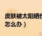 皮膚被太陽曬傷了怎么辦（皮膚被太陽曬傷了怎么辦）