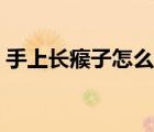 手上長(zhǎng)瘊子怎么去除（手上長(zhǎng)瘊子怎么去除）