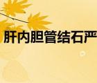 肝內膽管結石嚴重嗎（肝內膽管結石嚴重嗎）