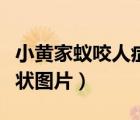 小黃家蟻咬人癥狀用什么藥（小黃家蟻咬人癥狀圖片）