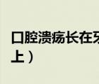 口腔潰瘍長在牙齦上圖片（口腔潰瘍長在牙齦上）