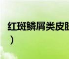 紅斑鱗屑類皮膚病（什么是紅斑鱗屑性皮膚?。?/>
                                    </a>
                                                </div>
                                    <div   id=