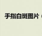 手指白斑圖片（指甲和肉分離是怎么回事）