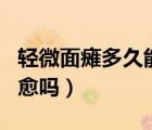 輕微面癱多久能恢復(fù)正常（輕微面癱幾天能自愈嗎）