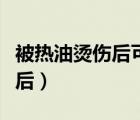 被熱油燙傷后可以涂新鮮蘆薈嗎（被熱油燙傷后）