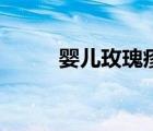 嬰兒玫瑰疹治療（玫瑰疹的治療）