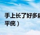 手上長了好多扁平疣用治嗎（手上長了好多扁平疣）