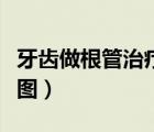 牙齒做根管治療是不是就廢了（根管治療步驟圖）