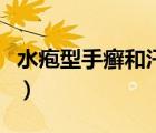 水皰型手癬和汗皰疹有什么區(qū)別（水皰型手癬）