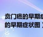 賁門(mén)癌的早期癥狀圖片最佳手術(shù)方案（賁門(mén)癌的早期癥狀圖）