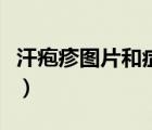 汗皰疹圖片和癥狀圖片怎么治療（汗皰疹圖片）