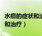 水痘的癥狀和治療一般幾天能好（水痘的癥狀和治療）
