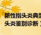 膿性指頭炎典型的臨床表現(xiàn)是選擇題（膿性指頭炎鑒別診斷）