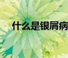 什么是銀屑病癥狀特征（什么是銀屑病）