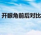 開眼角前后對比圖失?。ㄩ_眼角前后對比圖）