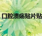 口腔潰瘍貼片貼哪一面圖解（口腔潰瘍貼片）