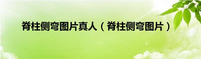 脊柱側(cè)彎圖片真人（脊柱側(cè)彎圖片）