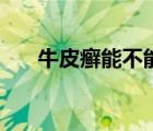 牛皮癬能不能根治（牛皮癬能根治嗎）