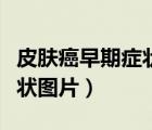 皮膚癌早期癥狀圖片皮膚瘙癢（皮膚癌早期癥狀圖片）