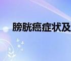膀胱癌癥狀及表現(xiàn)（膀胱癌有什么癥狀）
