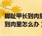 腳趾甲長到肉里怎么辦拔掉多少錢（腳趾甲長到肉里怎么辦）