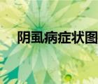 陰虱病癥狀圖片（長(zhǎng)菜花是什么病圖片）
