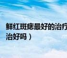 鮮紅斑痣最好的治療方法（鮮紅斑痣能治愈嗎 鮮紅斑痣可以治好嗎）