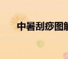 中暑刮痧圖解（中暑刮痧位置和方法）