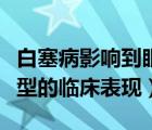 白塞病影響到眼睛怎么治療（白塞病眼部最典型的臨床表現(xiàn)）