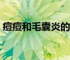 痘痘和毛囊炎的區(qū)別（毛囊炎和痘痘的區(qū)別）