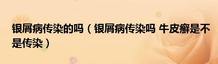 銀屑病傳染的嗎（銀屑病傳染嗎 牛皮癬是不是傳染）