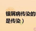 銀屑病傳染的嗎（銀屑病傳染嗎 牛皮癬是不是傳染）