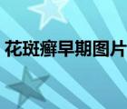 花斑癬早期圖片用什么藥（花斑癬早期圖片）