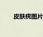 皮膚疣圖片怎么治療（皮膚疣圖片）