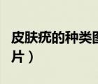 皮膚疣的種類圖片用什么藥（皮膚疣的種類圖片）