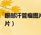眼部汗管瘤圖片是什么樣子的（眼部汗管瘤圖片）
